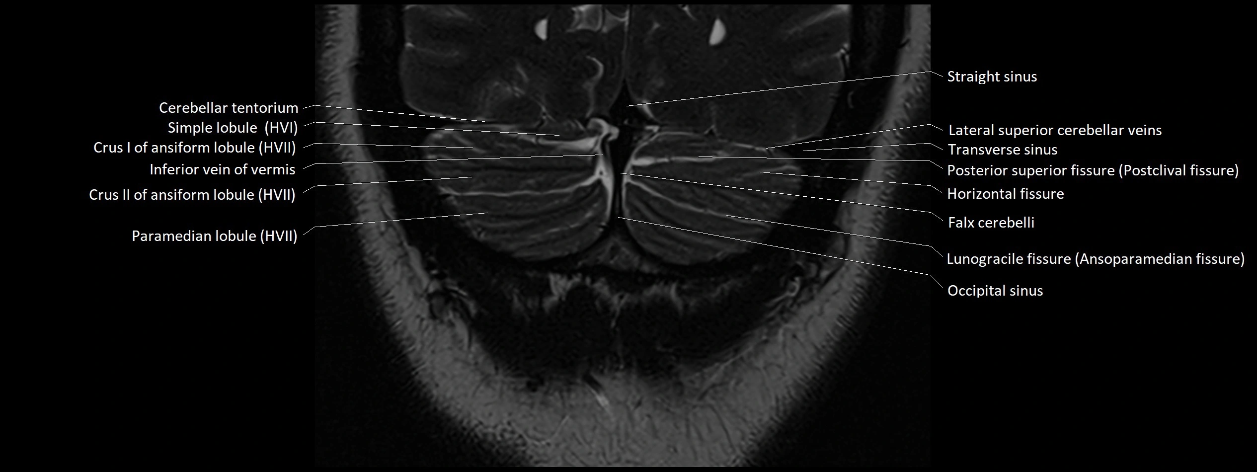 Anatomy of cerebellum coronal cross sectional 3T image 28.webp